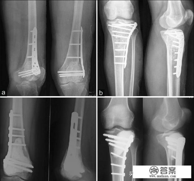 骨折手术取自己骨头好吗？