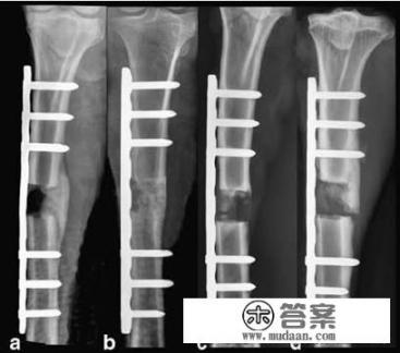 骨折手术取自己骨头好吗？
