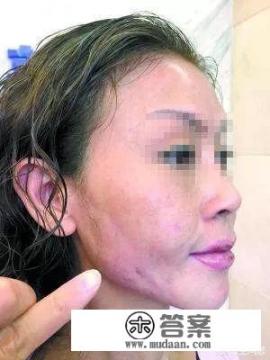 如何确定奥美定取出的最佳时机？