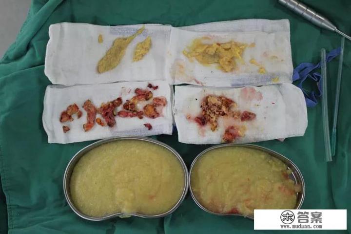 如何确定奥美定取出的最佳时机？