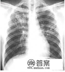 什么是肺结核？