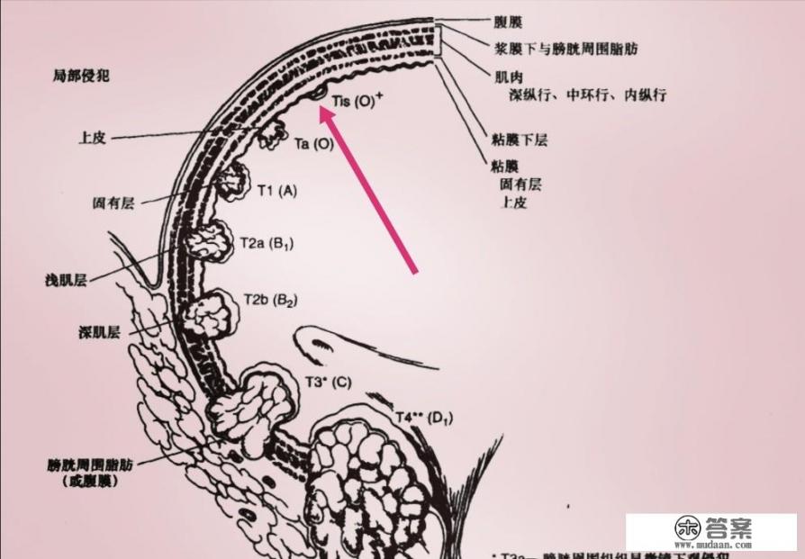 什么是原位癌？