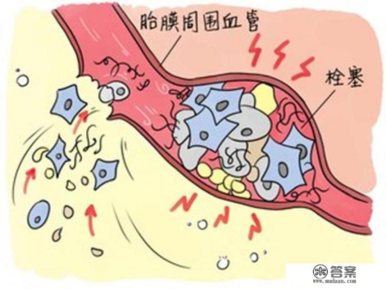 产妇羊水栓塞是什么意思? 产妇羊水栓塞是什么意思?