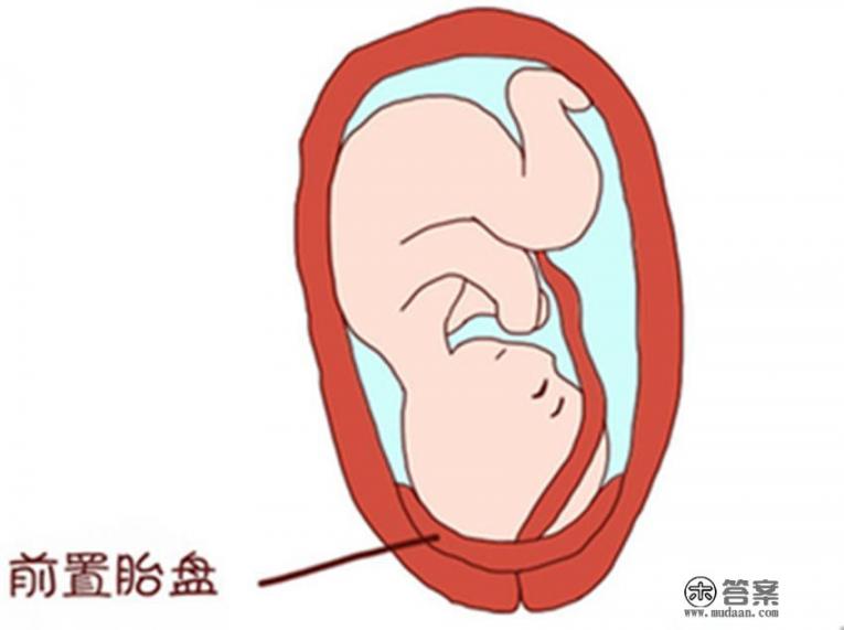 产妇羊水栓塞是什么意思? 产妇羊水栓塞是什么意思?