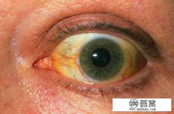 肝病可以治愈吗? 肝病可以治愈吗?