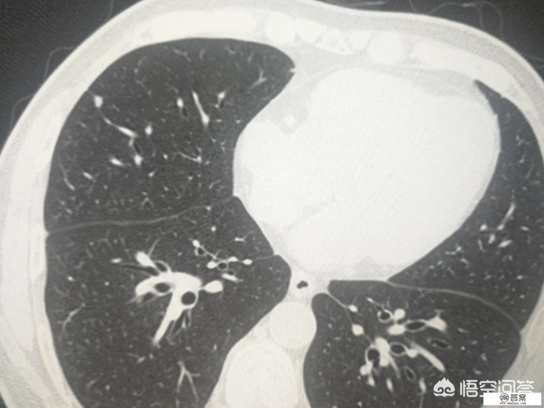 什么是结节?什么原因引起的呢? 什么是结节?什么原因引起的呢?