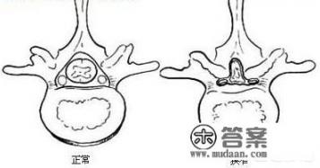 颈椎椎管狭窄在医院挂什么科？
