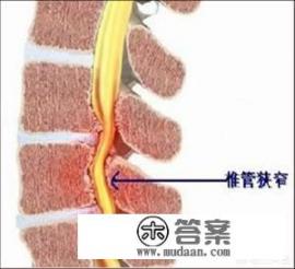 颈椎椎管狭窄在医院挂什么科？