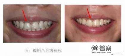 四环素牙是什么意思？