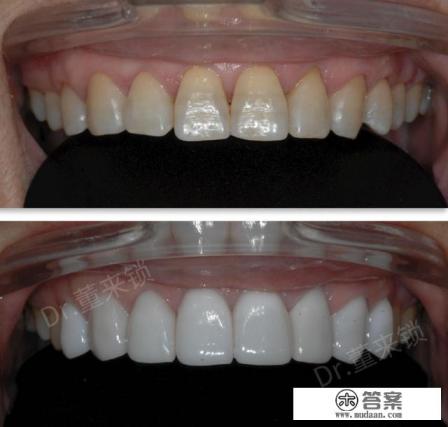 四环素牙是什么意思？