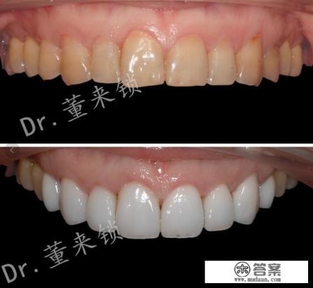 四环素牙是什么意思？