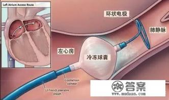 房颤的治疗方法有哪些? 房颤的治疗方法有哪些?