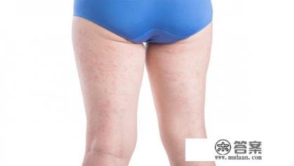 荨麻疹的别名？