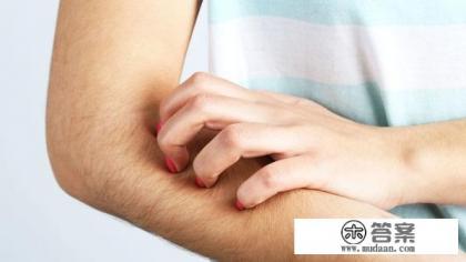 荨麻疹的别名？