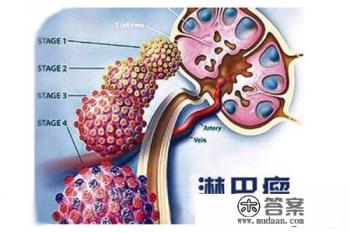 淋巴癌是什么？