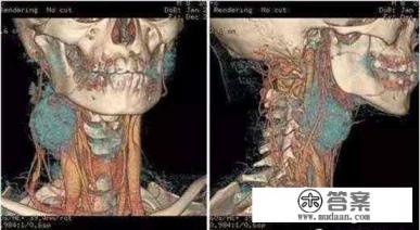 淋巴癌是什么？