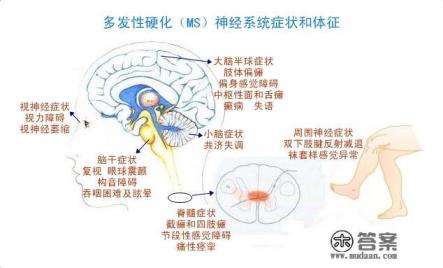 什么是多发性硬化？