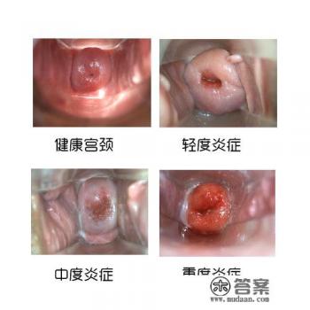 宫颈糜烂的危害有哪些？会引起不孕吗？