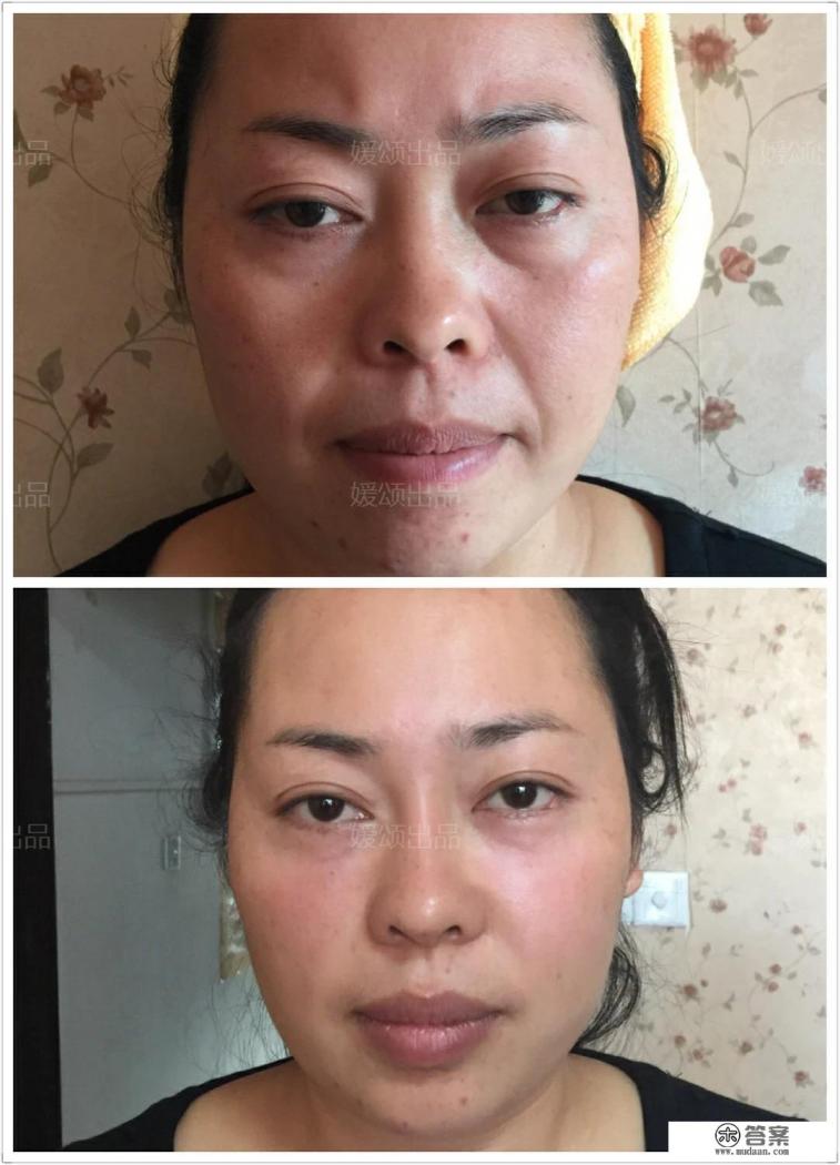 不熬夜泪沟会恢复吗？