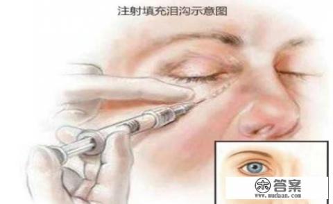 不熬夜泪沟会恢复吗？