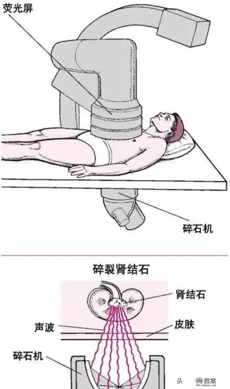 体外冲击波碎石效果那么好，为什么大医院医生不用，还是建议手术？