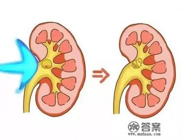体外冲击波碎石效果那么好，为什么大医院医生不用，还是建议手术？