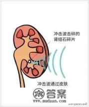 体外冲击波碎石效果那么好，为什么大医院医生不用，还是建议手术？