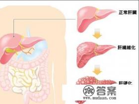 肝硬化需要遵守的6大饮食原则是什么?