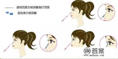 什么是假体隆鼻？