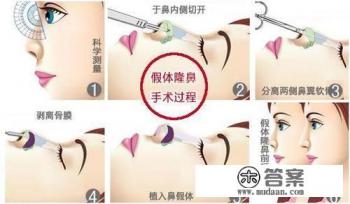 什么是假体隆鼻？