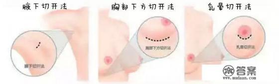 隆胸能喂奶吗？