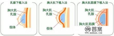 隆胸能喂奶吗？