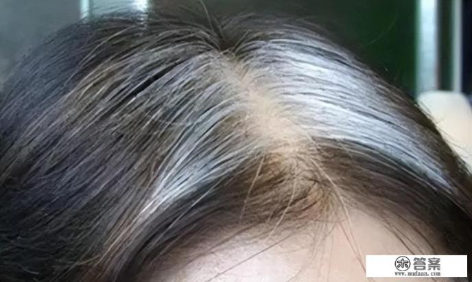 熬夜和精神紧张，长出来的白头发还能变黑回来吗？