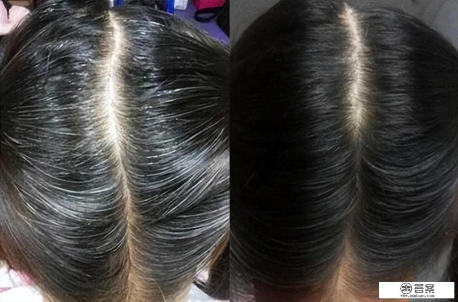 熬夜和精神紧张，长出来的白头发还能变黑回来吗？