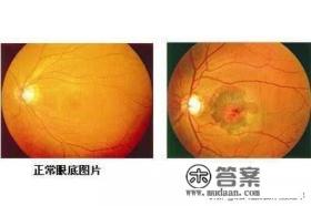 眼底黄斑病变最有效的治疗方法?