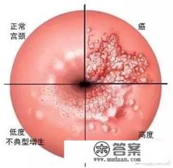 利普刀治疗后注意事项?