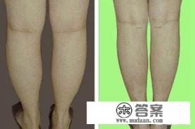 打botox瘦腿有用么? 打botox瘦腿有用么?