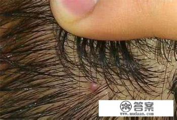 头皮有油脂粒,用什么洗发水好? 头皮有油脂粒,用什么洗发水好?