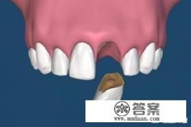 牙齿缺失了怎么修复比较好？