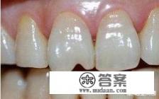 牙齿缺失了怎么修复比较好？