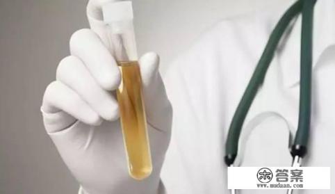 大量蛋白尿能治好吗? 大量蛋白尿能治好吗?