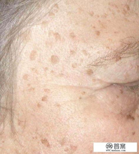 怎样快速去除老年斑？