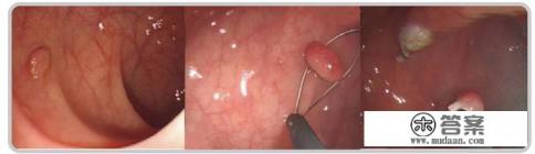 做完肠息肉多长时间能好? 做完肠息肉多长时间能好?