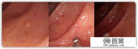 做完肠息肉多长时间能好? 做完肠息肉多长时间能好?