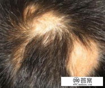斑秃怎么回事？