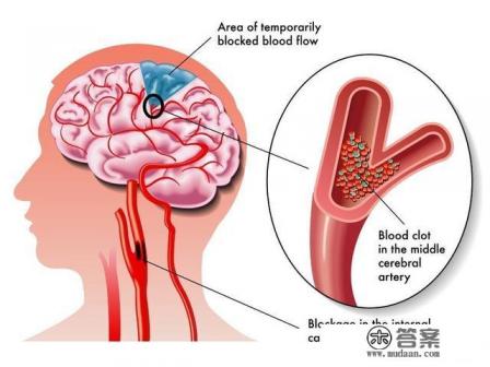 脑梗塞能痊愈吗？