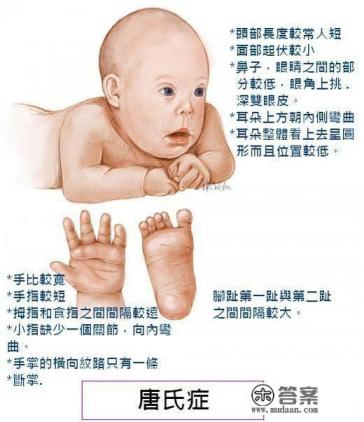 唐氏综合征是什么? 唐氏综合征是什么?