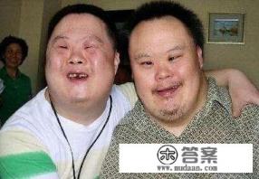 唐氏综合征是什么? 唐氏综合征是什么?