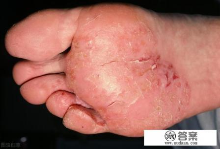 足癣怎么治？