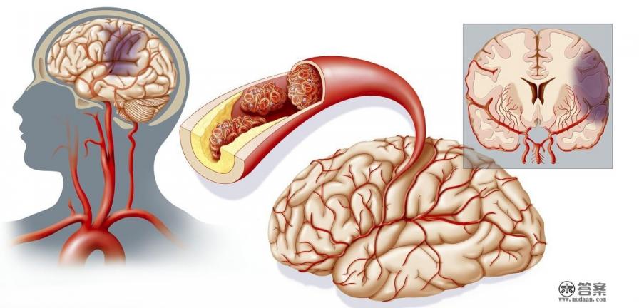 血栓是怎么形成的,怎么样才能防止血栓形成？
